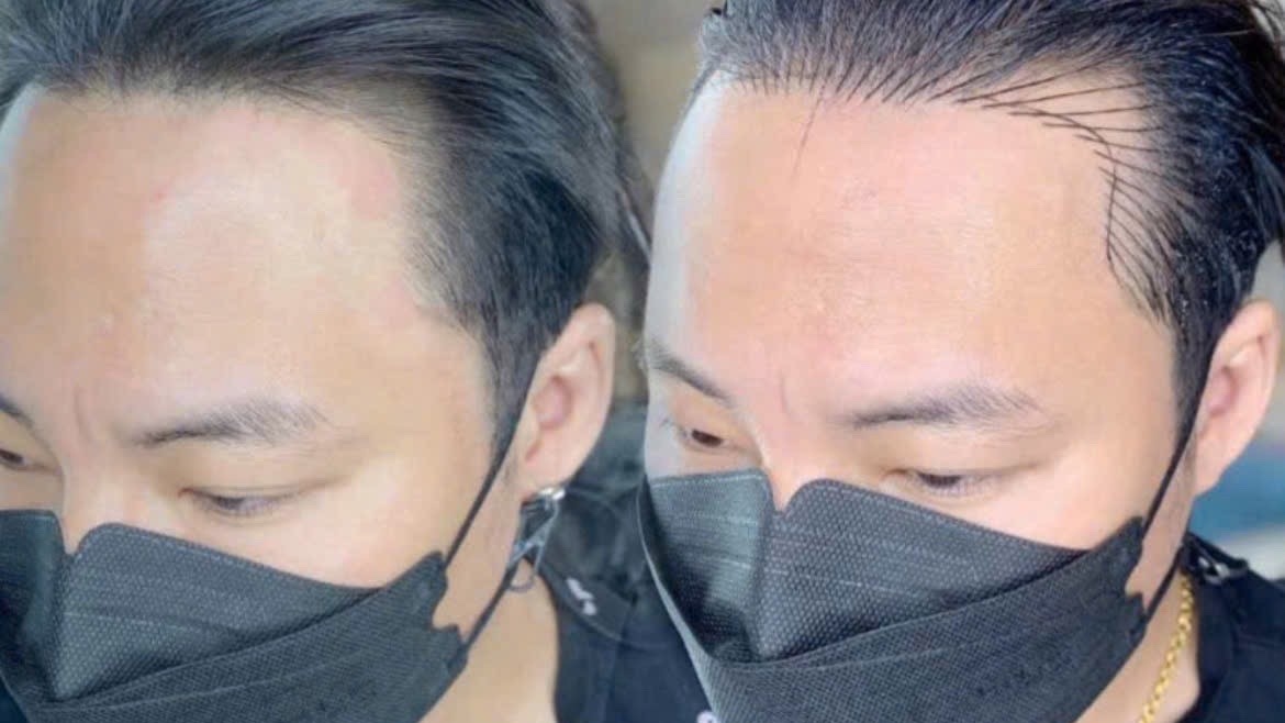 SMP Hairline in Ho Chi Minh City for Men