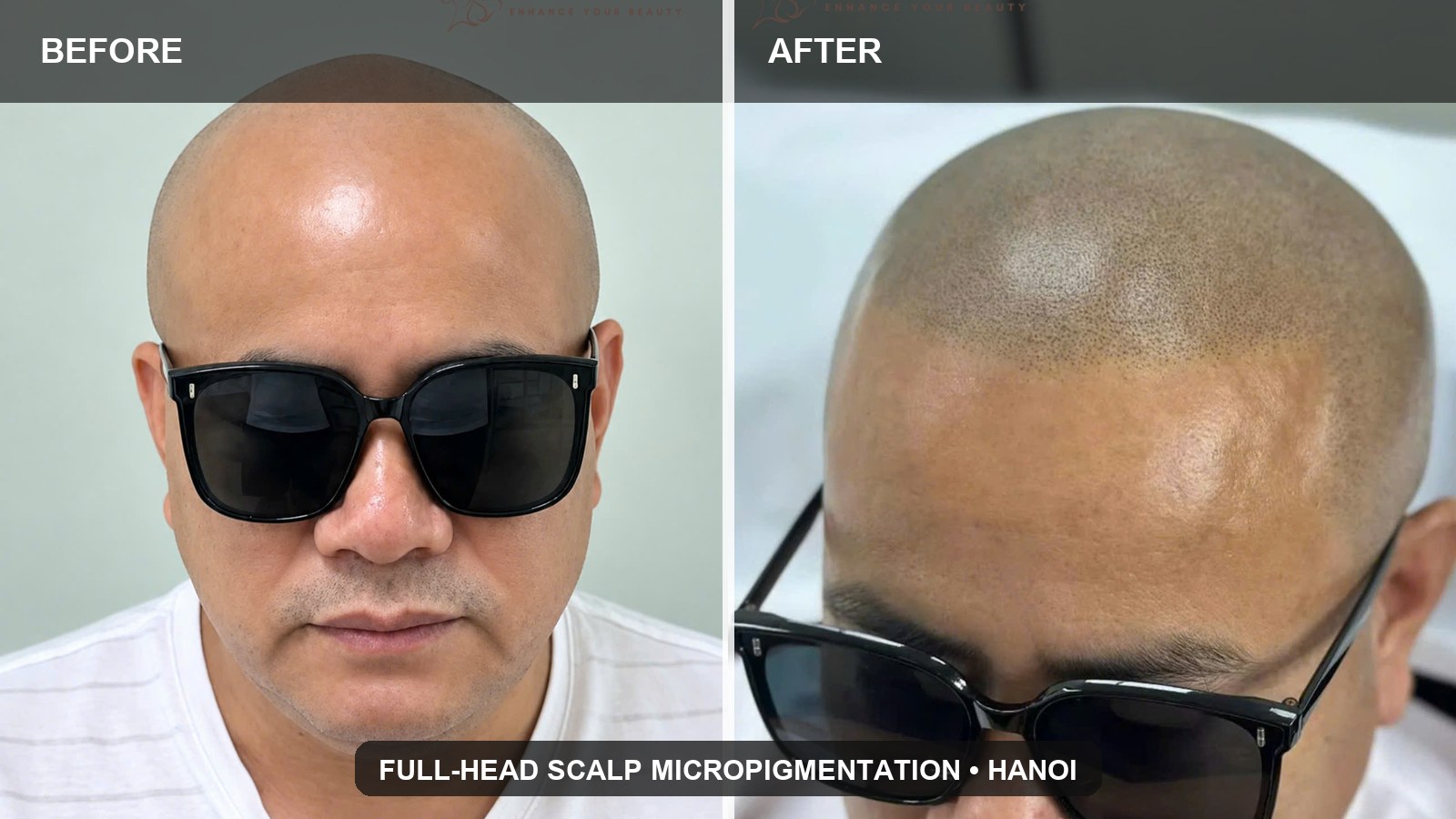 Scalp Micropigmentation in Hanoi for Men